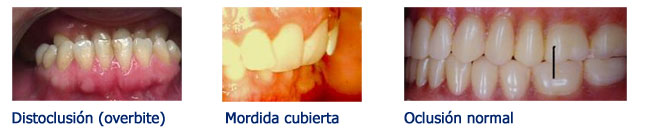 Ortodoncia y terapia miofuncional