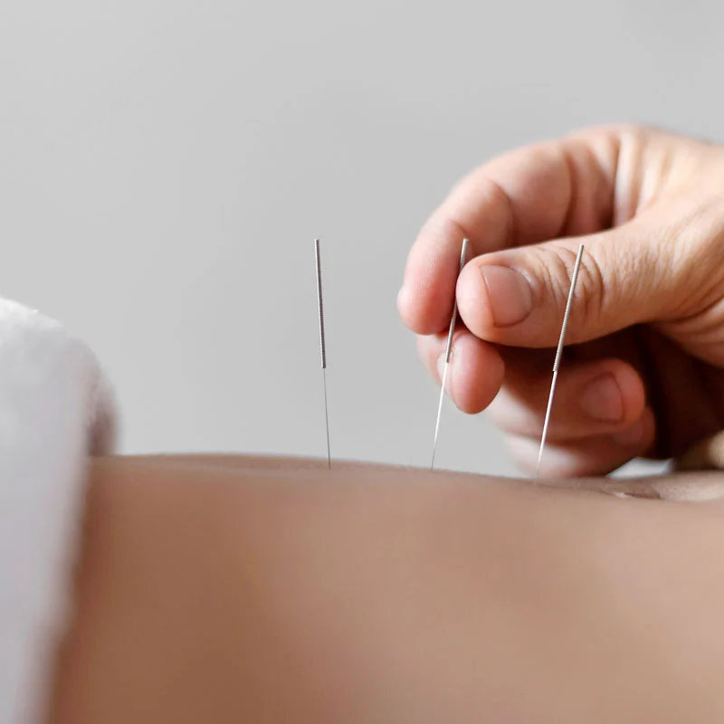 Sesión de acupuntura y rehabilitación en Motyva Sesión de acupuntura y rehabilitación en Motyva