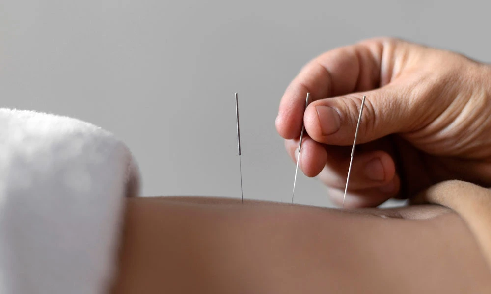 Sesión de acupuntura y rehabilitación Sesión de acupuntura y rehabilitación